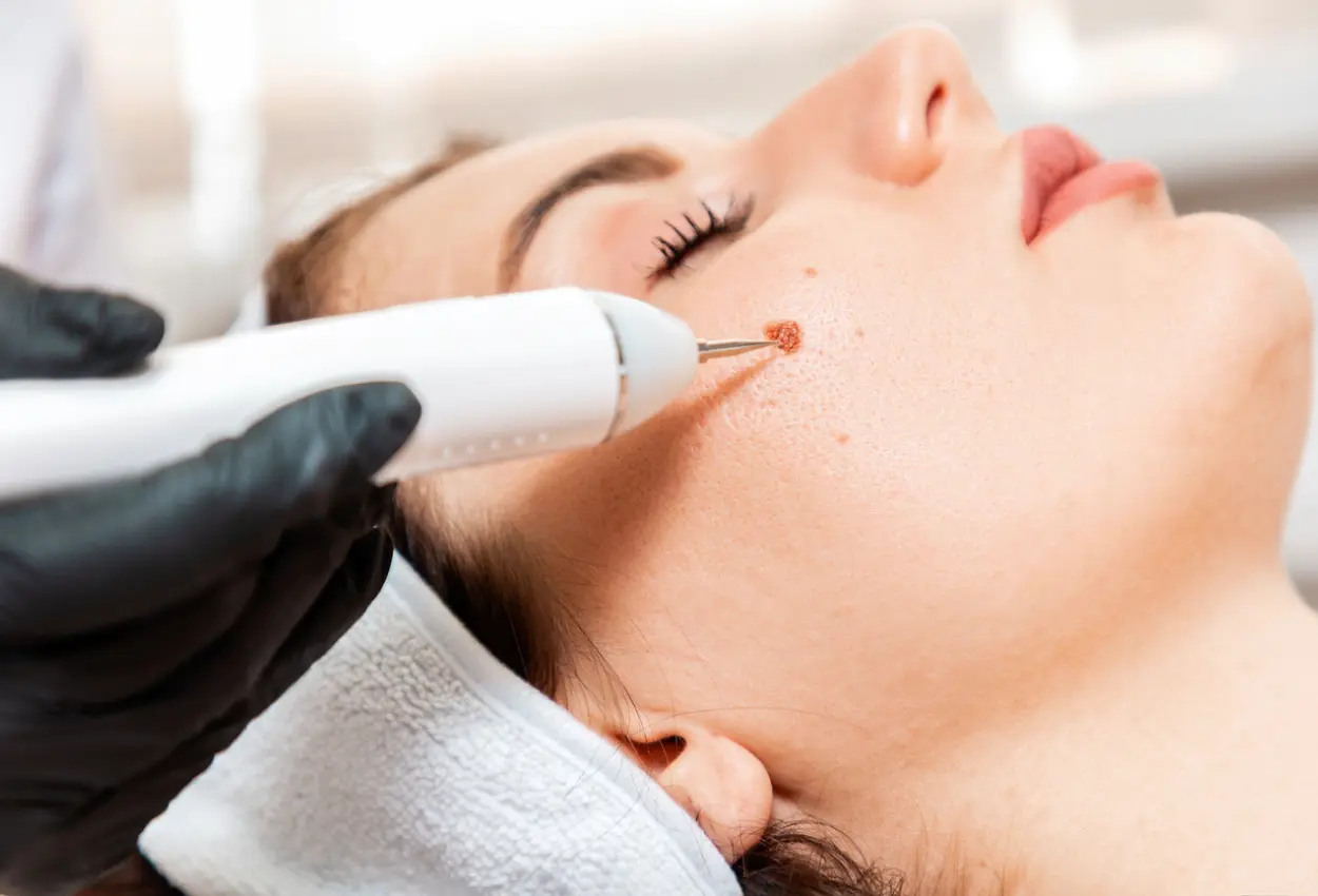 Frequently Asked Questions About Multiple Cryotherapy Treatments Walsall