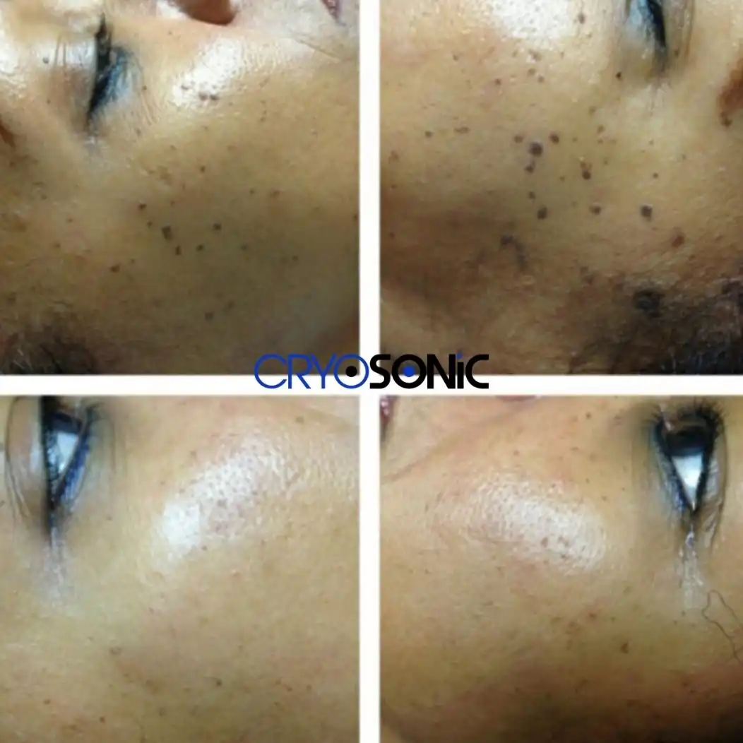 Why Skin Shows Pigmentation After Treatment Walsall