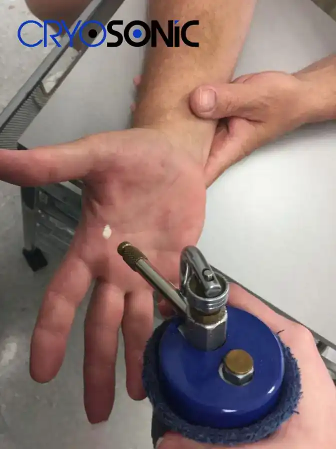 Temperature Differences: OTC vs Medical-Grade Cryotherapy Walsall
